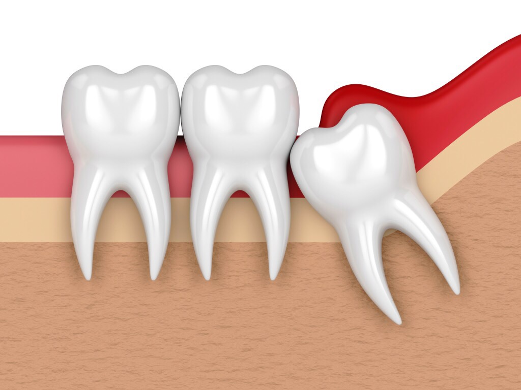 Impaction tooth